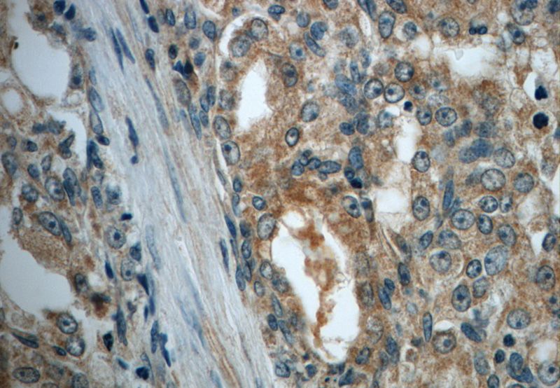 Immunohistochemistry of paraffin-embedded human prostate cancer slide using Catalog No:112704(MMP26 Antibody) at dilution of 1:50