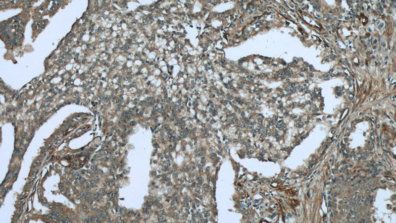 Immunohistochemistry of paraffin-embedded human prostate cancer tissue slide using Catalog No:115799(STX6 Antibody) at dilution of 1:50 (under 10x lens)