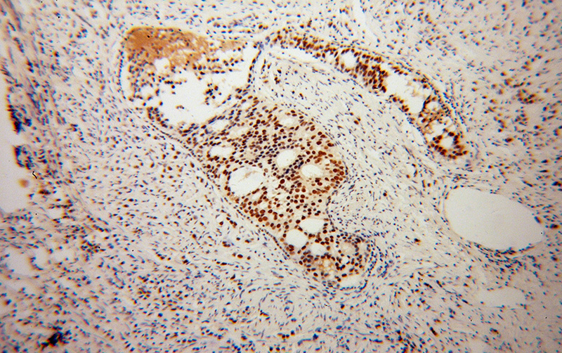 Immunohistochemical of paraffin-embedded human gliomas using Catalog No:112038(KHDRBS3 antibody) at dilution of 1:100 (under 10x lens)