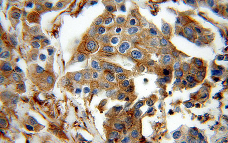 Immunohistochemical of paraffin-embedded human breast cancer using Catalog No:107712(ACTN4 antibody) at dilution of 1:100 (under 40x lens)