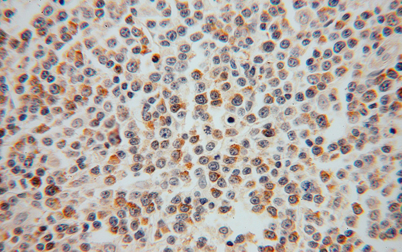 Immunohistochemical of paraffin-embedded human lymphoma using Catalog No:115079(SEC24A antibody) at dilution of 1:50 (under 40x lens)