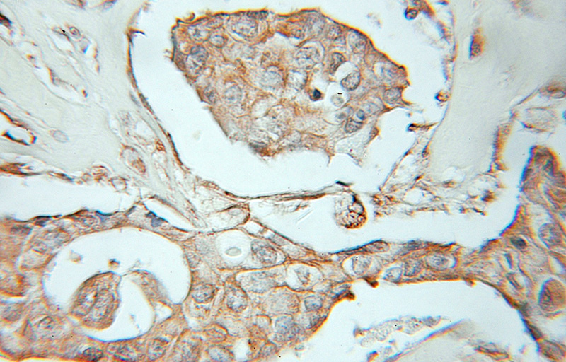 Immunohistochemical of paraffin-embedded human breast cancer using Catalog No:110643(FGFR4 antibody) at dilution of 1:10 (under 10x lens)