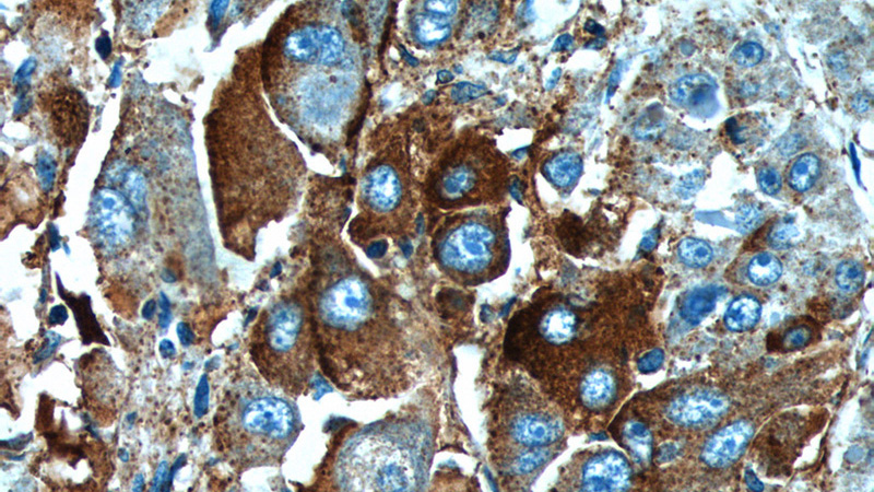 Immunohistochemistry of paraffin-embedded human liver cancer tissue slide using Catalog No:111329(HABP2 Antibody) at dilution of 1:100 (under 40x lens).