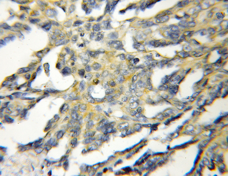 Immunohistochemical of paraffin-embedded human ovary tumor using Catalog No:112260(KYNU antibody) at dilution of 1:50 (under 10x lens)