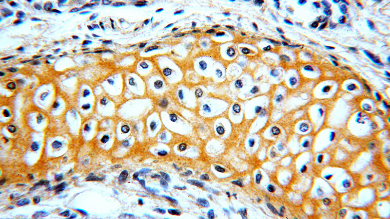 Immunohistochemical of paraffin-embedded human lung using Catalog No:114406(RAB11B-Specific antibody) at dilution of 1:100 (under 40x lens)