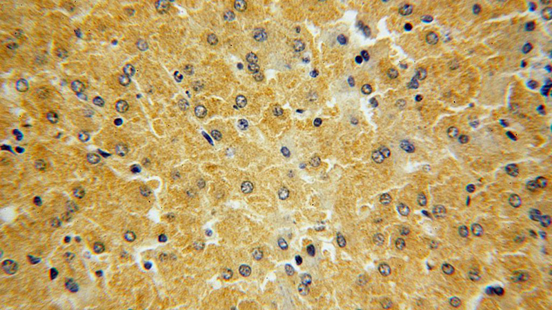 Immunohistochemical of paraffin-embedded human liver using Catalog No:111313(HGD antibody) at dilution of 1:100 (under 40x lens)