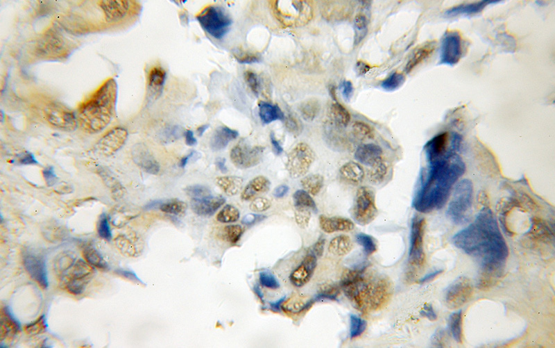 Immunohistochemical of paraffin-embedded human lung cancer using Catalog No:115135(SF3A3 antibody) at dilution of 1:50 (under 10x lens)