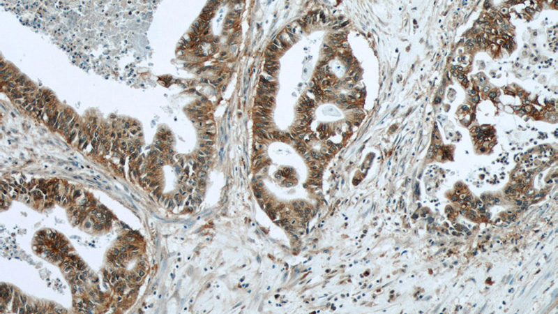Immunohistochemical of paraffin-embedded human pancreas cancer using Catalog No:112121(KRAS-2B-speicifc antibody) at dilution of 1:50 (under 10x lens)