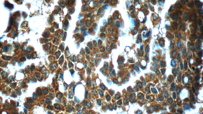 Immunohistochemistry of paraffin-embedded human ovary tumor slide using Catalog No:111784(IMPDH1 Antibody) at dilution of 1:50