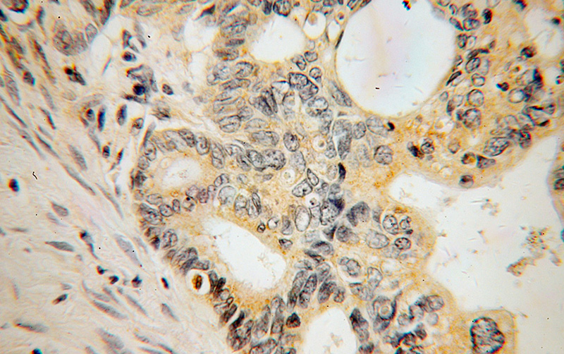 Immunohistochemical of paraffin-embedded human liver cancer using Catalog No:109864(DAPP1 antibody) at dilution of 1:100 (under 40x lens)