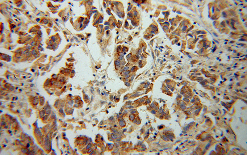 Immunohistochemical of paraffin-embedded human prostate cancer using Catalog No:109681(CYP17A1 antibody) at dilution of 1:100 (under 40x lens)