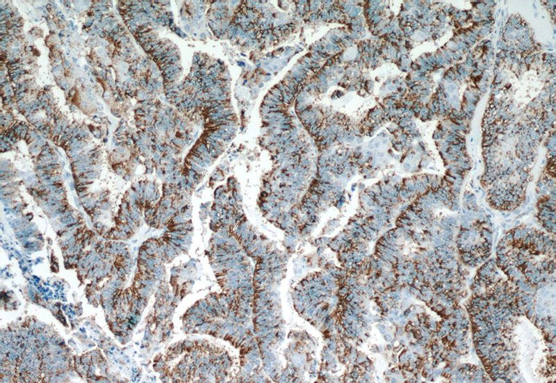 Immunohistochemistry of paraffin-embedded human ovary tumor tissue slide using Catalog No:114222(SERPINA5 Antibody) at dilution of 1:50 (under 10x lens)