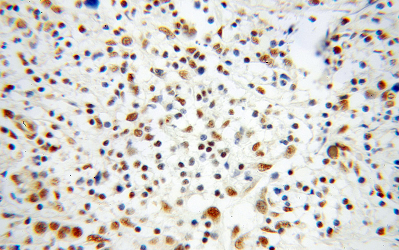 Immunohistochemical of paraffin-embedded human breast cancer using Catalog No:116113(THUMPD1 antibody) at dilution of 1:100 (under 40x lens)