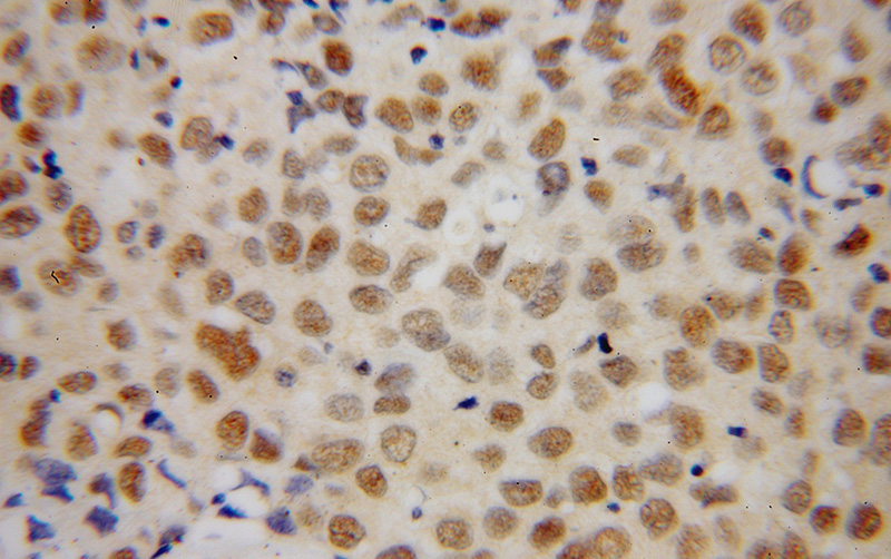 Immunohistochemical of paraffin-embedded human breast cancer using Catalog No:111065(GPKOW antibody) at dilution of 1:100 (under 40x lens)
