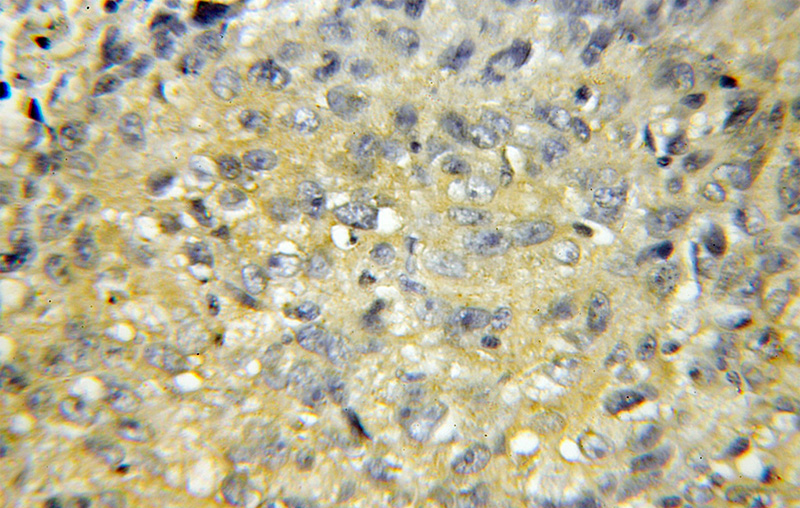 Immunohistochemical of paraffin-embedded human lung cancer using Catalog No:115968(TACC2 antibody) at dilution of 1:100 (under 10x lens)