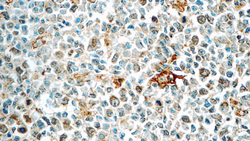 Immunohistochemistry of paraffin-embedded human tonsillitis tissue slide using Catalog No:109387(CLEC9A Antibody) at dilution of 1:50 (under 40x lens)