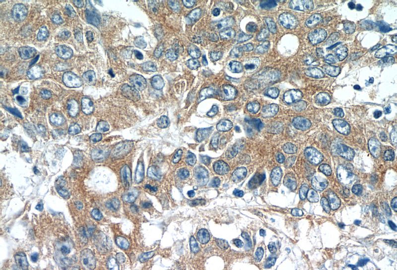 Immunohistochemistry of paraffin-embedded human colon cancer tissue slide using Catalog No:112722(MOBKL3 Antibody) at dilution of 1:50 (under 40x lens)