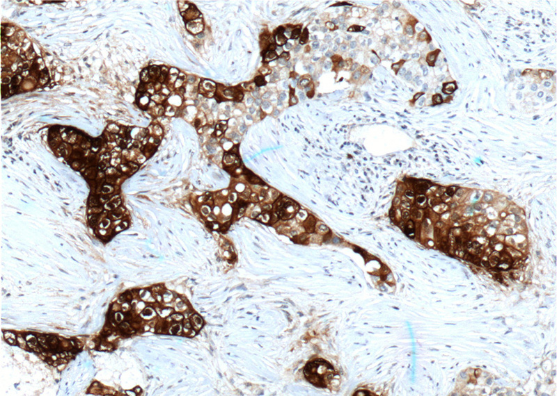 Immunohistochemistry of paraffin-embedded human breast cancer tissue slide using Catalog No:107413(SCGB2A2 Antibody) at dilution of 1:200 (under 10x lens). heat mediated antigen retrieved with Tris-EDTA buffer(pH9).
