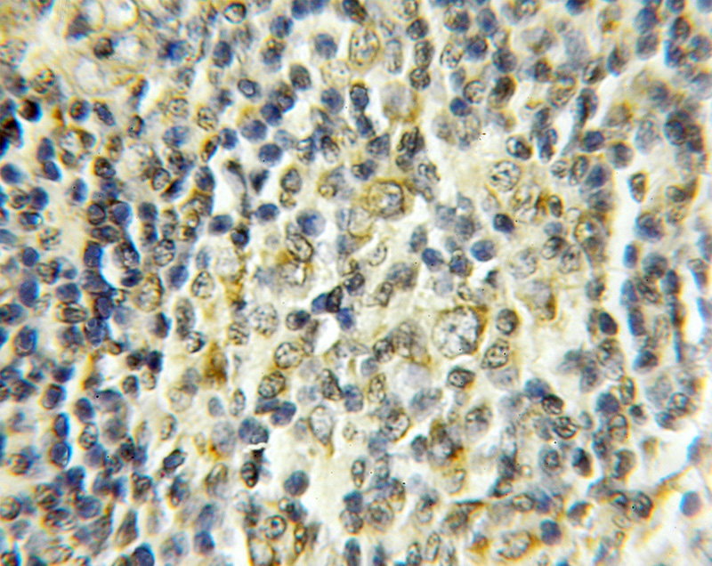 Immunohistochemical of paraffin-embedded human lymphoma using Catalog No:109486(COX17 antibody) at dilution of 1:50 (under 10x lens)