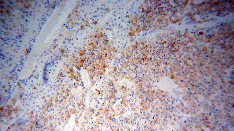 Immunohistochemical of paraffin-embedded human liver cancer using Catalog No:113747(PCOLCE antibody) at dilution of 1:100 (under 10x lens)