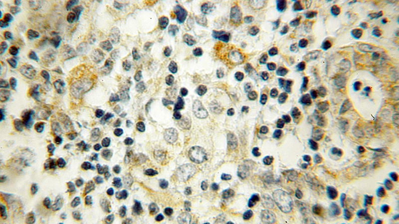 Immunohistochemical of paraffin-embedded human breast cancer using Catalog No:116665(UBTD2 antibody) at dilution of 1:100 (under 10x lens)