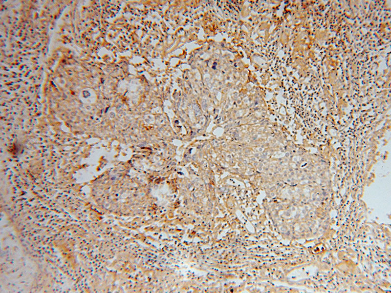 Immunohistochemical of paraffin-embedded human ovary tumor using Catalog No:110995(GNB2 antibody) at dilution of 1:50 (under 10x lens)