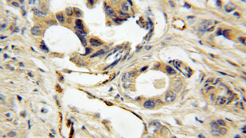Immunohistochemical of paraffin-embedded human prostate cancer using Catalog No:112180(LDB3 antibody) at dilution of 1:50 (under 10x lens)