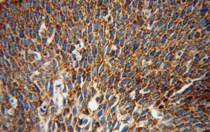Immunohistochemical of paraffin-embedded human cervical cancer using Catalog No:109473(COQ9 antibody) at dilution of 1:100 (under 40x lens)