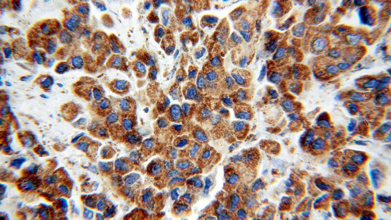 Immunohistochemical of paraffin-embedded human breast cancer using Catalog No:111933(IRS1 antibody) at dilution of 1:100 (under 40x lens)
