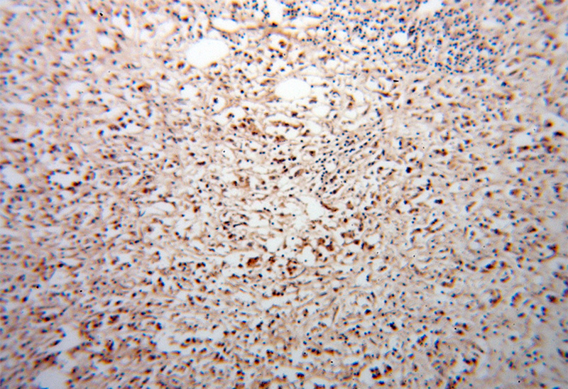 Immunohistochemical of paraffin-embedded human breast cancer using Catalog No:114955(S100A11 antibody) at dilution of 1:50 (under 10x lens)