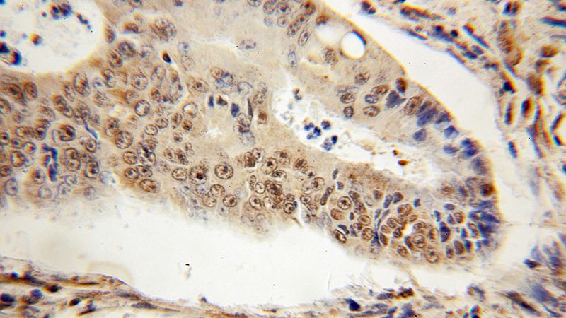 Immunohistochemical of paraffin-embedded human colon cancer using Catalog No:113302(NONO antibody) at dilution of 1:50 (under 10x lens)