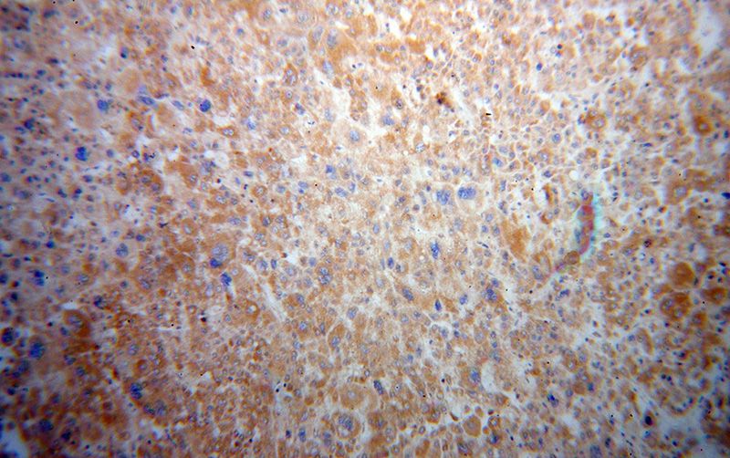 Immunohistochemical of paraffin-embedded human liver cancer using Catalog No:114830(RPS15 antibody) at dilution of 1:100 (under 10x lens)
