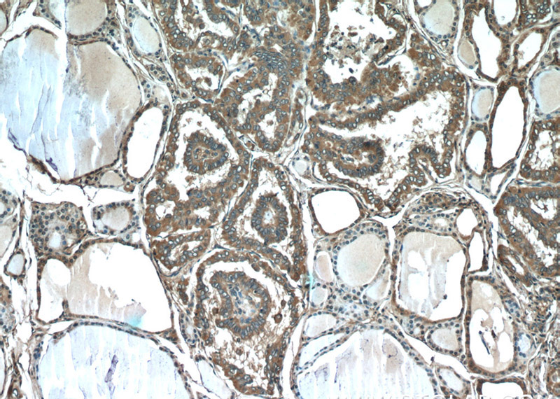 Immunohistochemistry of paraffin-embedded human thyroid cancer tissue slide using Catalog No:115496(SLC5A5 Antibody) at dilution of 1:50 (under 10x lens)