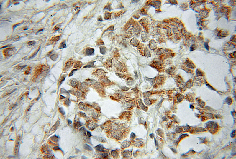Immunohistochemical of paraffin-embedded human breast cancer using Catalog No:114270(PTGES2 antibody) at dilution of 1:50 (under 40x lens)