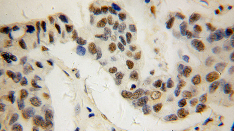 Immunohistochemical of paraffin-embedded human breast cancer using Catalog No:107941(AKR1C3 antibody) at dilution of 1:100 (under 40x lens)