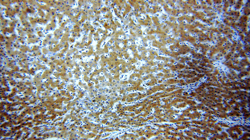 Immunohistochemical of paraffin-embedded human hepatocirrhosis using Catalog No:107664(A1BG antibody) at dilution of 1:50 (under 10x lens)