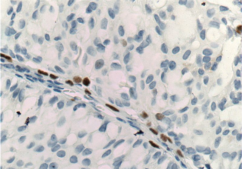 Immunohistochemistry of paraffin-embedded human breast hyperplasia tissue slide using Catalog No:113558(TP63 Antibody) at dilution of 1:200 (under 40x lens)