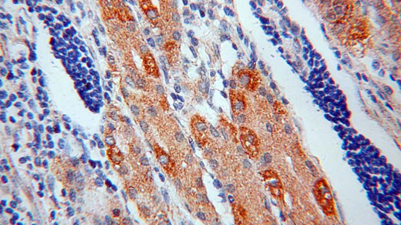 Immunohistochemical of paraffin-embedded human stomach cancer using Catalog No:115785(ARIP2; SYNJ2BP antibody) at dilution of 1:50 (under 40x lens)