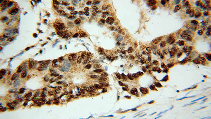 Immunohistochemical of paraffin-embedded human colon cancer using Catalog No:110675(FKBP5 antibody) at dilution of 1:50 (under 40x lens)