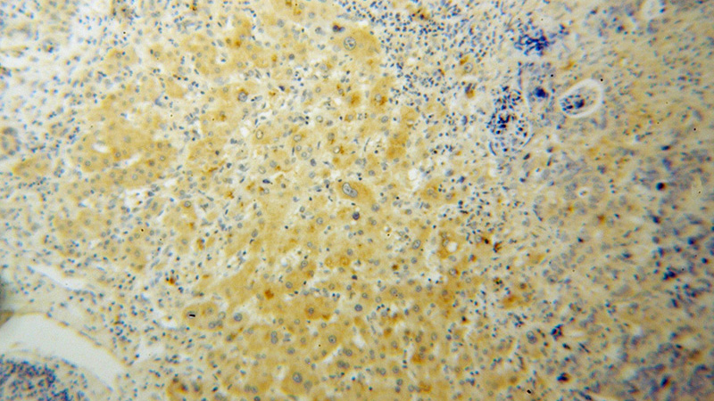 Immunohistochemical of paraffin-embedded human liver cancer using Catalog No:114883(RPL27 antibody) at dilution of 1:100 (under 10x lens)