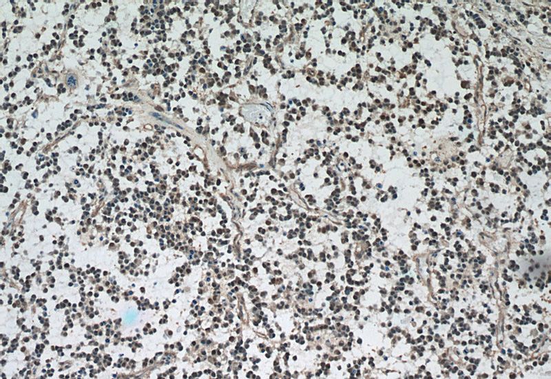 Immunohistochemistry of paraffin-embedded human gliomas tissue slide using Catalog No:107538(VCP Antibody) at dilution of 1:50 (under 10x lens)
