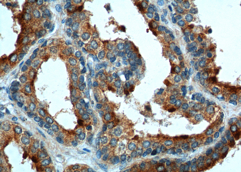 Immunohistochemistry of paraffin-embedded human prostate hyperplasia tissue slide using Catalog No:108404(BAD Antibody) at dilution of 1:200 (under 40x lens)