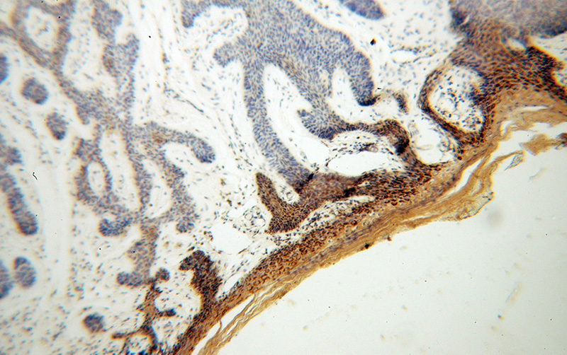 Immunohistochemical of paraffin-embedded human skin cancer using Catalog No:112132(KRT36 antibody) at dilution of 1:100 (under 10x lens)