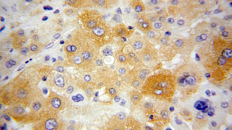 Immunohistochemical of paraffin-embedded human liver cancer using Catalog No:112955(NARS antibody) at dilution of 1:100 (under 40x lens)