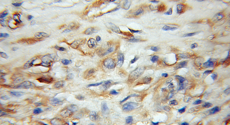 Immunohistochemical of paraffin-embedded human gliomas using Catalog No:110920(GDAP1L1 antibody) at dilution of 1:50 (under 10x lens)