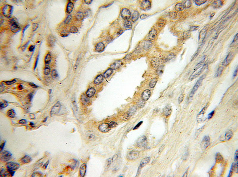Immunohistochemical of paraffin-embedded human prostate cancer using Catalog No:111685(IGFBP2 antibody) at dilution of 1:50 (under 10x lens)