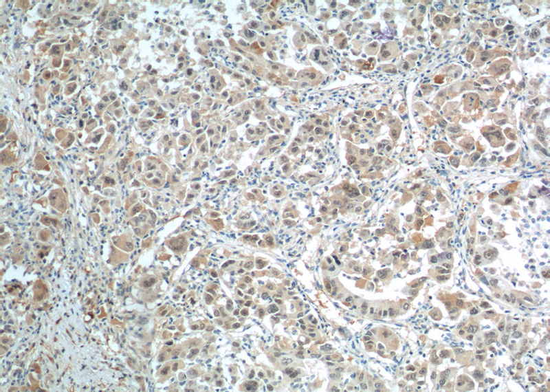 Immunohistochemistry of paraffin-embedded human liver cancer tissue slide using Catalog No:117104(BCL9 Antibody) at dilution of 1:200 (under 10x lens).