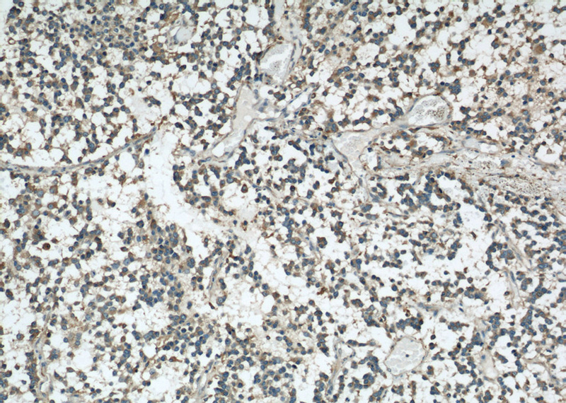 Immunohistochemical of paraffin-embedded human gliomas using Catalog No:116720(VAT1 antibody) at dilution of 1:50 (under 10x lens)