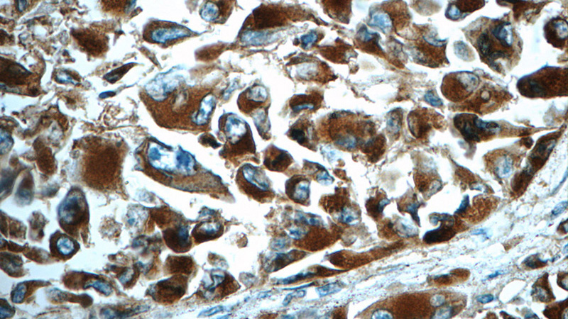 Immunohistochemistry of paraffin-embedded human malignant melanoma tissue slide using Catalog No:109133(CD63 Antibody) at dilution of 1:50 (under 40x lens)