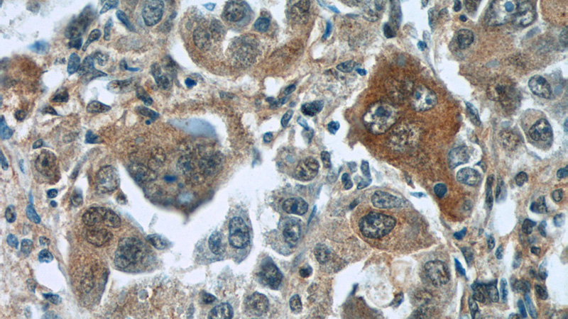 Immunohistochemistry of paraffin-embedded human liver cancer tissue slide using Catalog No:116161(TNS4 Antibody) at dilution of 1:50 (under 40x lens)